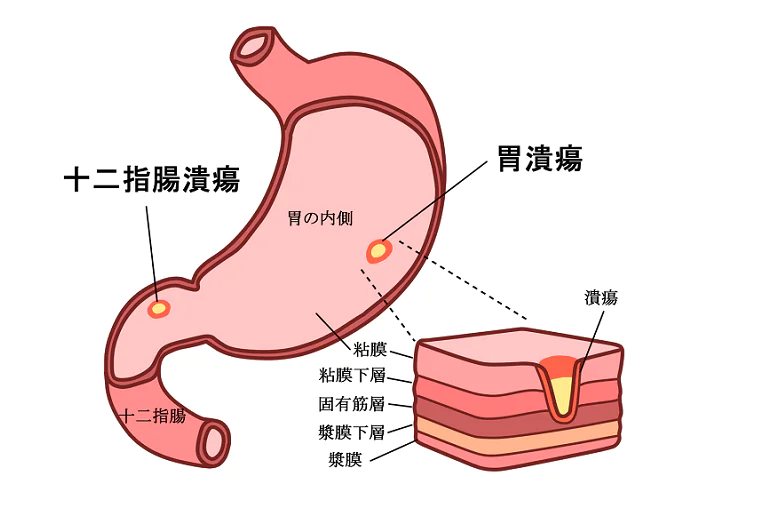 胃潰瘍とは