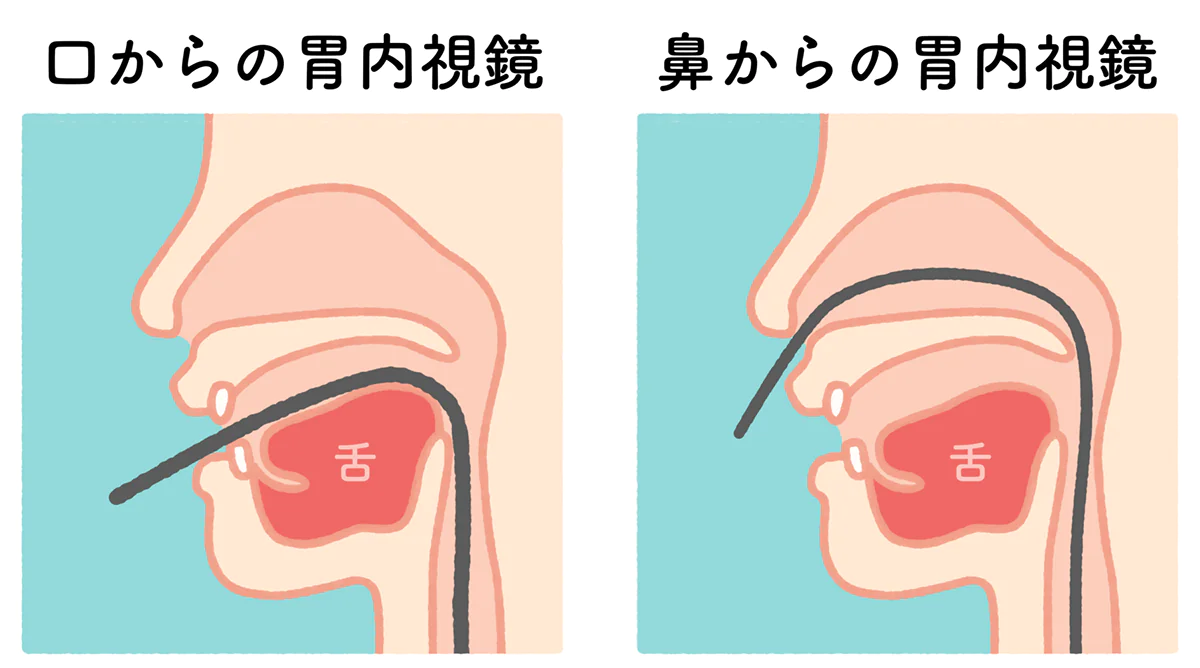 鼻からの胃カメラ検査も可能