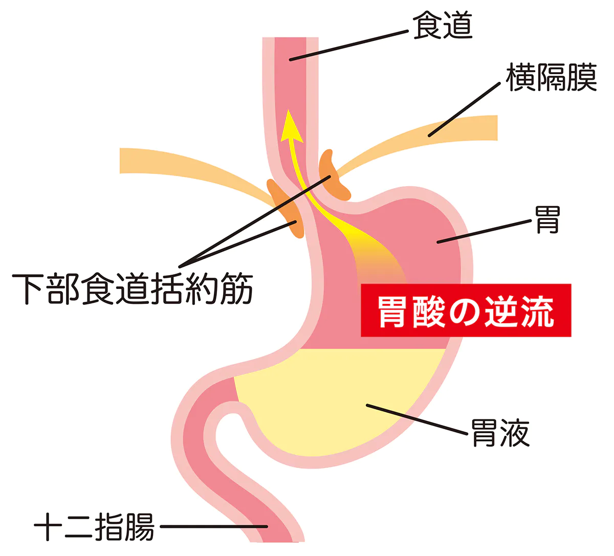 ストレスや姿勢も？逆流性食道炎の原因